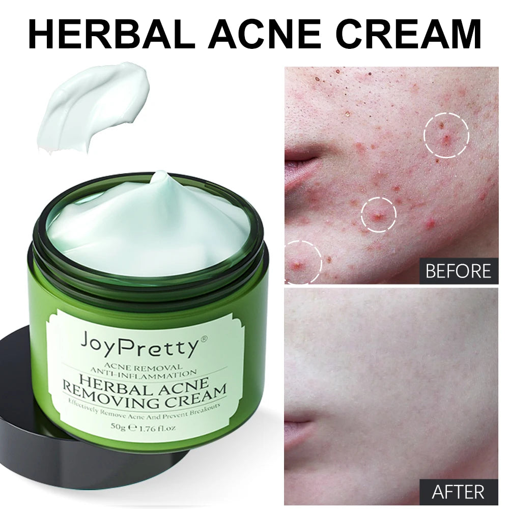 Herbal Acne Face Cream Pimple Marks Removal Oil Control Moisturizing Pockmark Smooth Facial Creams Skin Care Products JoyPretty